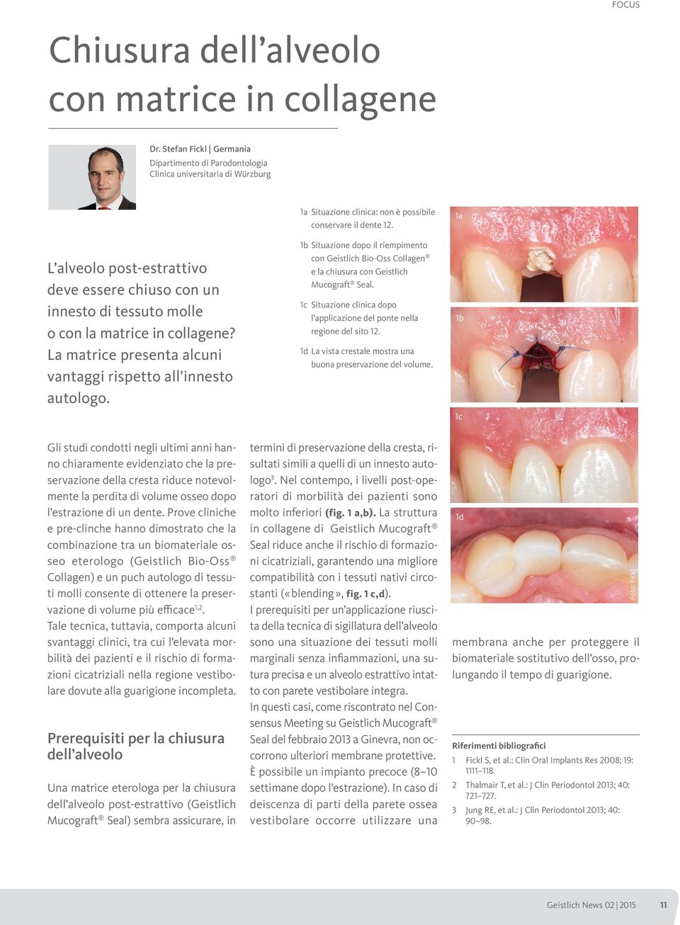 La matrice presenta alcuni vantaggi rispetto all innesto autologo. 1a Situazione clinica: non è possibile conservare il dente 12.