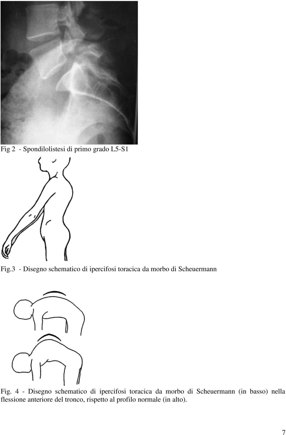 Fig. 4 - Disegno schematico di ipercifosi toracica da morbo di