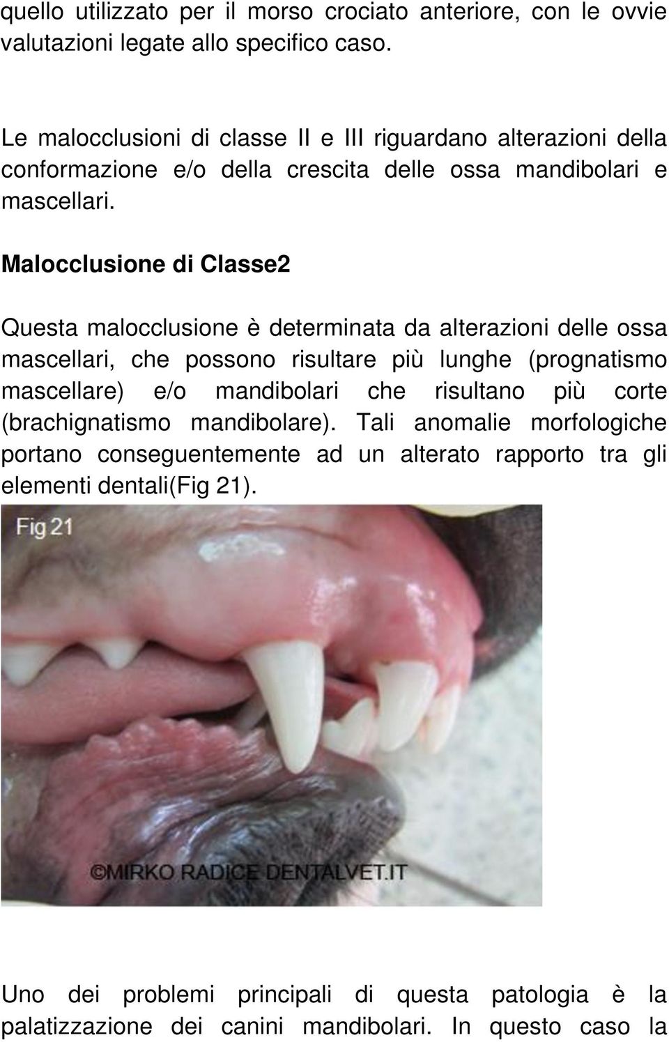 Malocclusione di Classe2 Questa malocclusione è determinata da alterazioni delle ossa mascellari, che possono risultare più lunghe (prognatismo mascellare) e/o