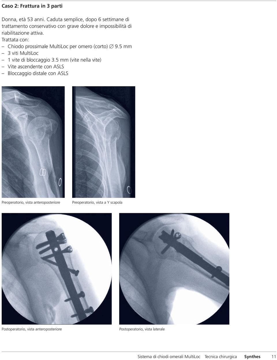 Trattata con: Chiodo prossimale MultiLoc per omero (corto) B 9.5 mm 3 viti MultiLoc 1 vite di bloccaggio 3.