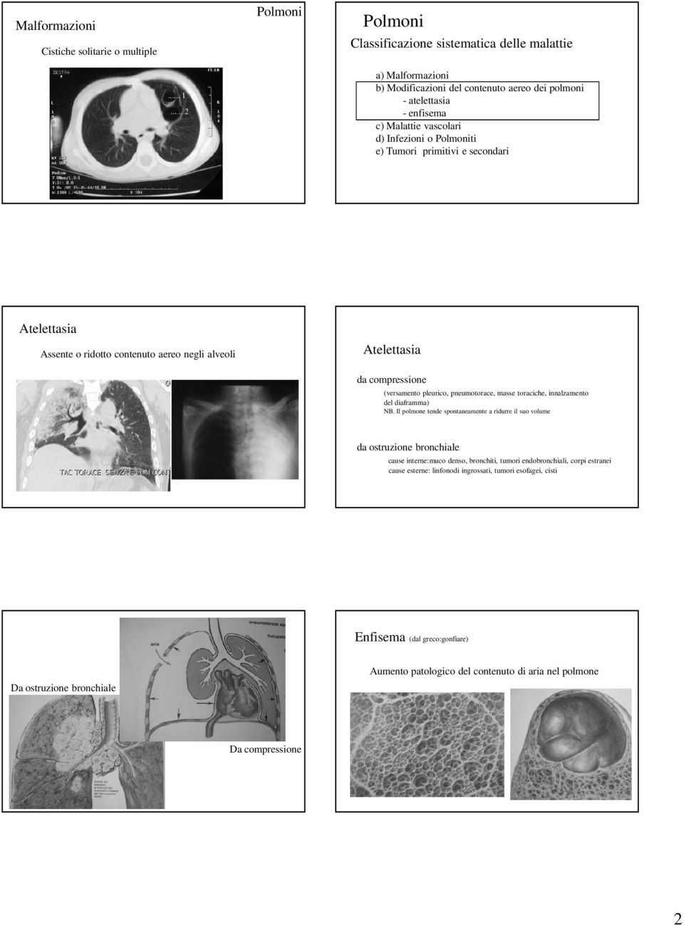 pneumotorace, masse toraciche, innalzamento del diaframma) NB.