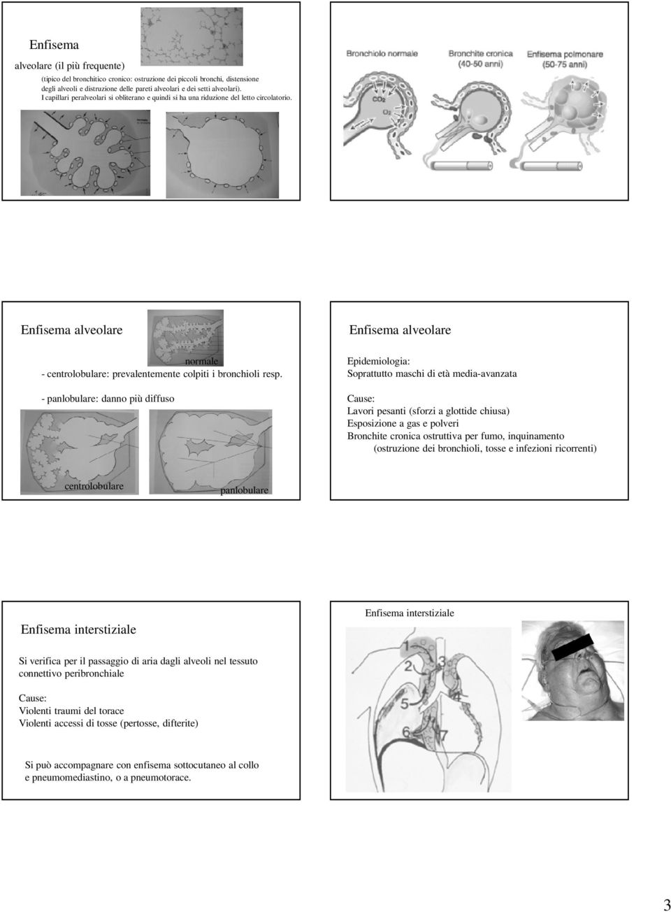 - panlobulare: danno più diffuso Enfisema alveolare Epidemiologia: Soprattutto maschi di età media-avanzata Cause: Lavori pesanti (sforzi a glottide chiusa) Esposizione a gas e polveri Bronchite