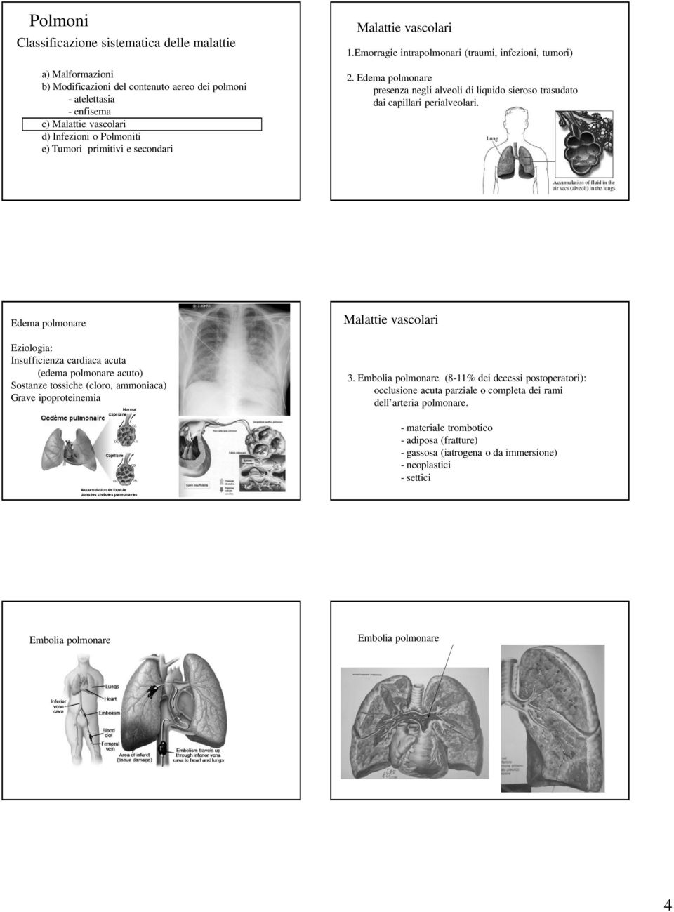 Edema polmonare Eziologia: Insufficienza cardiaca acuta (edema polmonare acuto) Sostanze tossiche (cloro, ammoniaca) Grave ipoproteinemia Malattie vascolari 3.