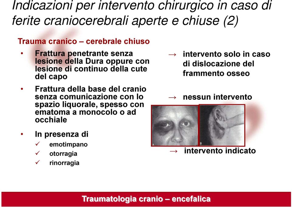 base del cranio senza comunicazione con lo spazio liquorale, spesso con ematoma a monocolo o ad occhiale In presenza di