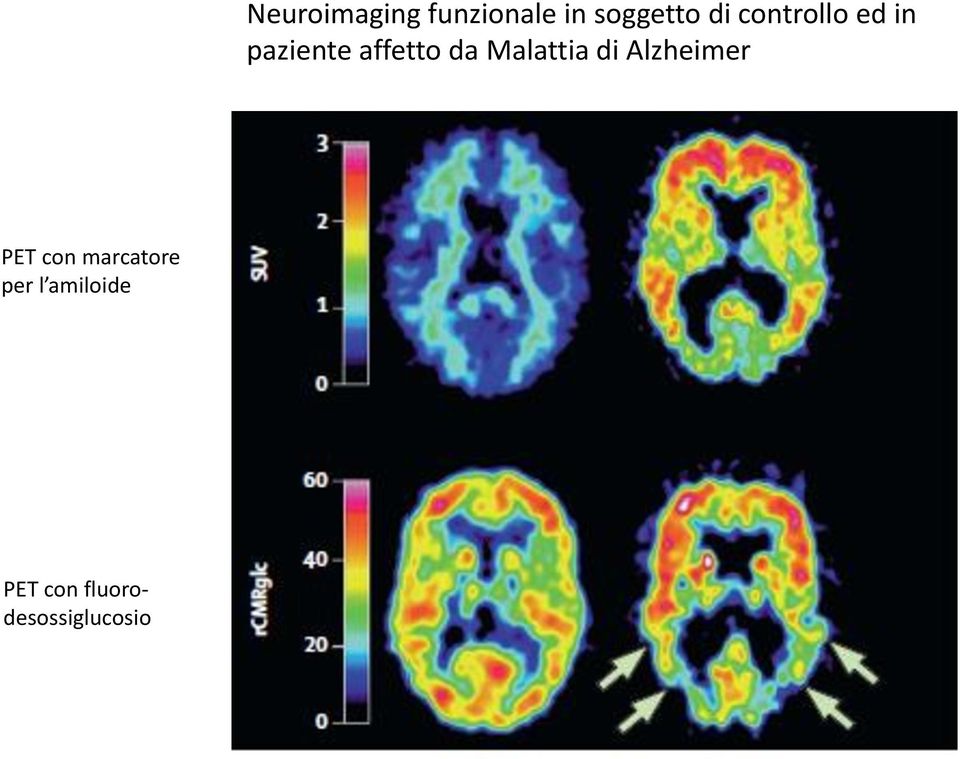 Malattia di Alzheimer PET con marcatore