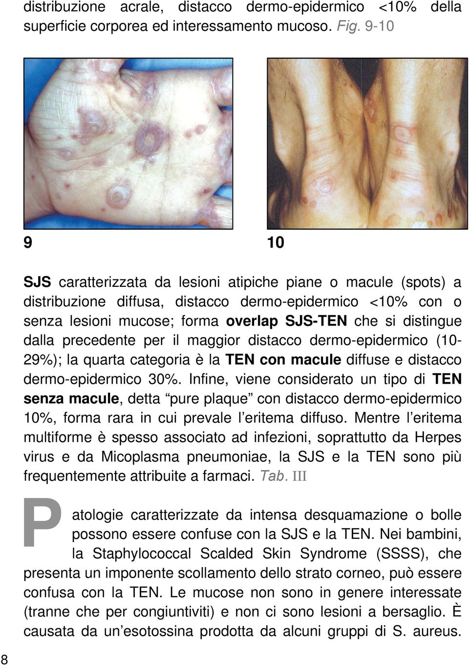 dalla precedente per il maggior distacco dermo-epidermico (10-29%); la quarta categoria è la TEN con macule diffuse e distacco dermo-epidermico 30%.