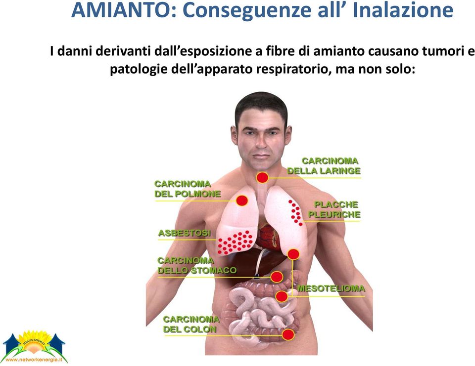 fibre di amianto causano tumori e