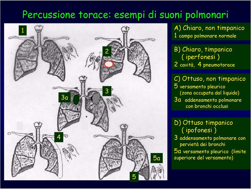 (zona occupata dal liquido) 3a addensamento polmonare con bronchi occlusi 4 5a D) Ottuso timpanico (
