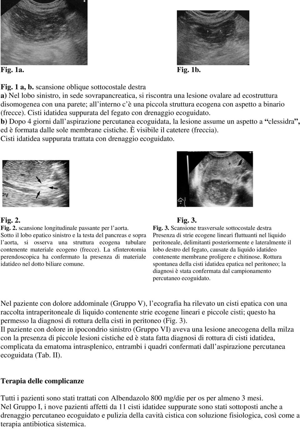 struttura ecogena con aspetto a binario (frecce). Cisti idatidea suppurata del fegato con drenaggio ecoguidato.