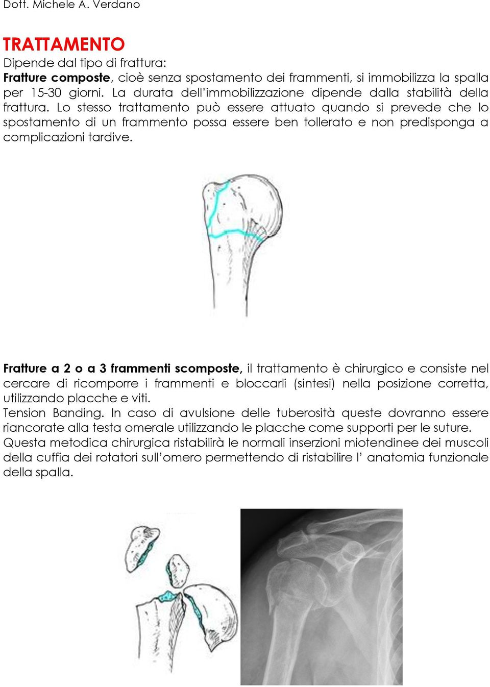 Lo stesso trattamento può essere attuato quando si prevede che lo spostamento di un frammento possa essere ben tollerato e non predisponga a complicazioni tardive.