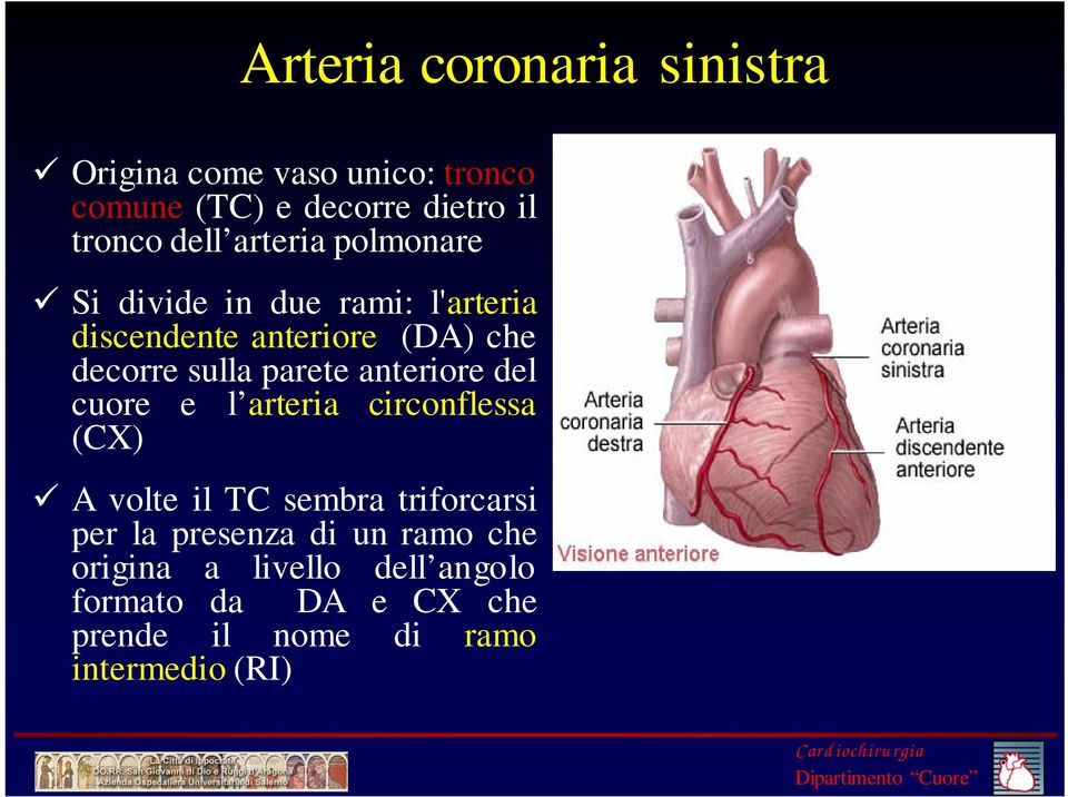 anteriore del cuore e l arteria circonflessa (CX) A volte il TC sembra triforcarsi per la presenza di