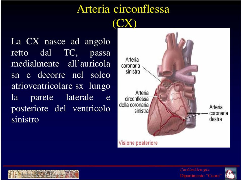 atrioventricolare sx lungo la parete laterale e