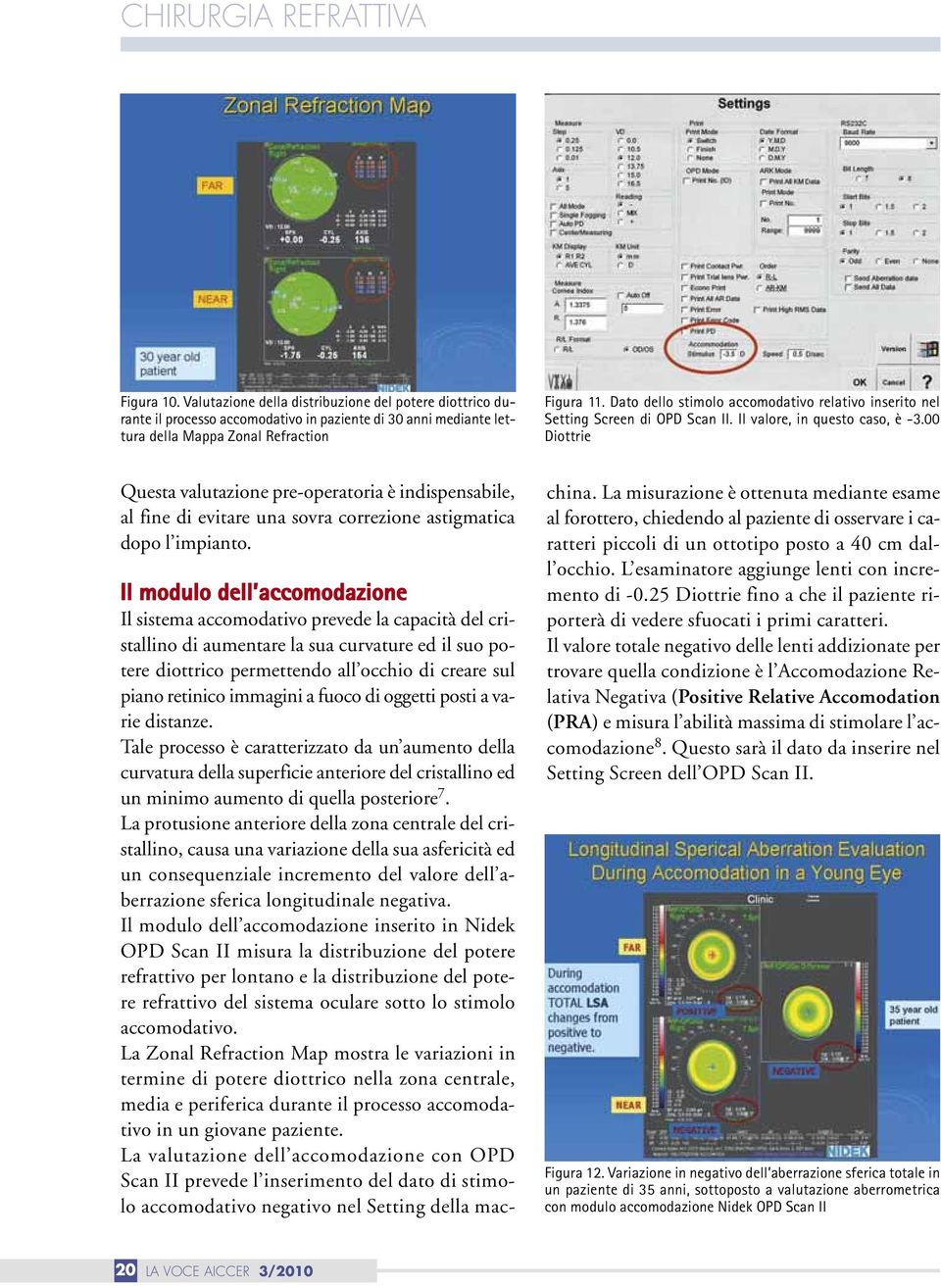 00 Diottrie Questa valutazione pre-operatoria è indispensabile, al fine di evitare una sovra correzione astigmatica dopo l impianto.