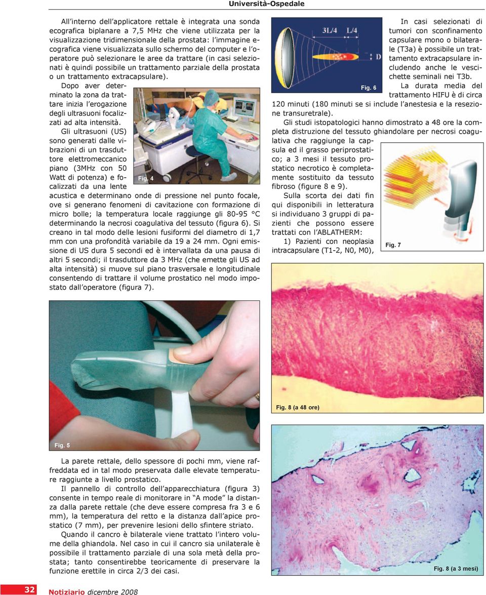 extracapsulare). Dopo aver determinato la zona da trattare inizia l erogazione degli ultrasuoni focalizzati ad alta intensità.