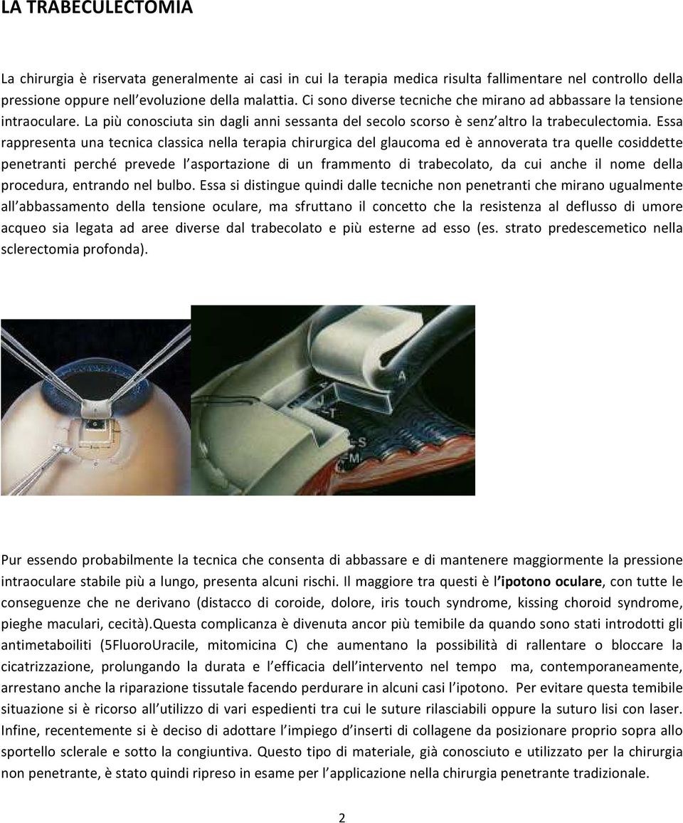 Essa rappresenta una tecnica classica nella terapia chirurgica del glaucoma ed è annoverata tra quelle cosiddette penetranti perché prevede l asportazione di un frammento di trabecolato, da cui anche