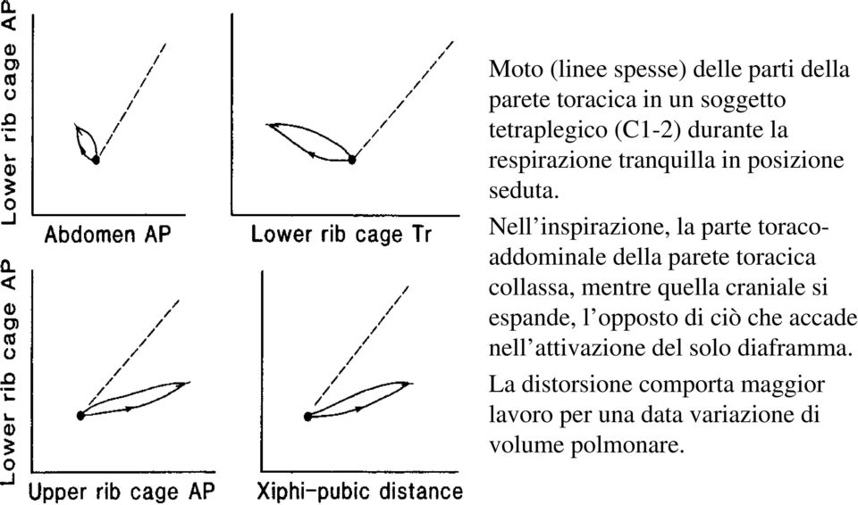 Nell inspirazione, la parte toracoaddominale della parete toracica collassa, mentre quella craniale