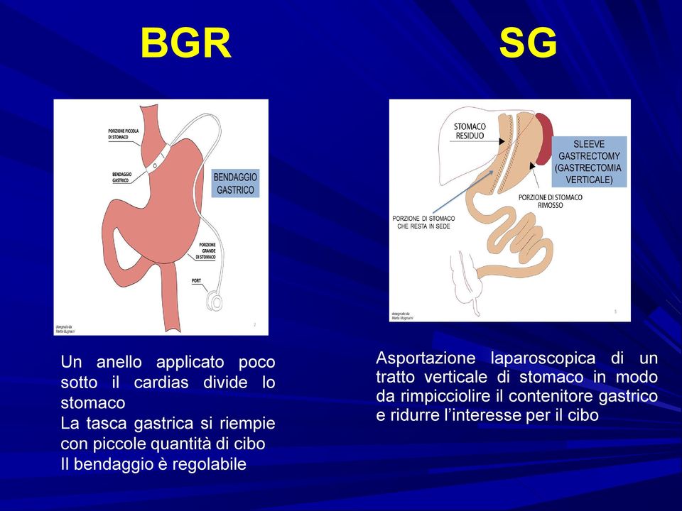 regolabile Asportazione laparoscopica di un tratto verticale di stomaco