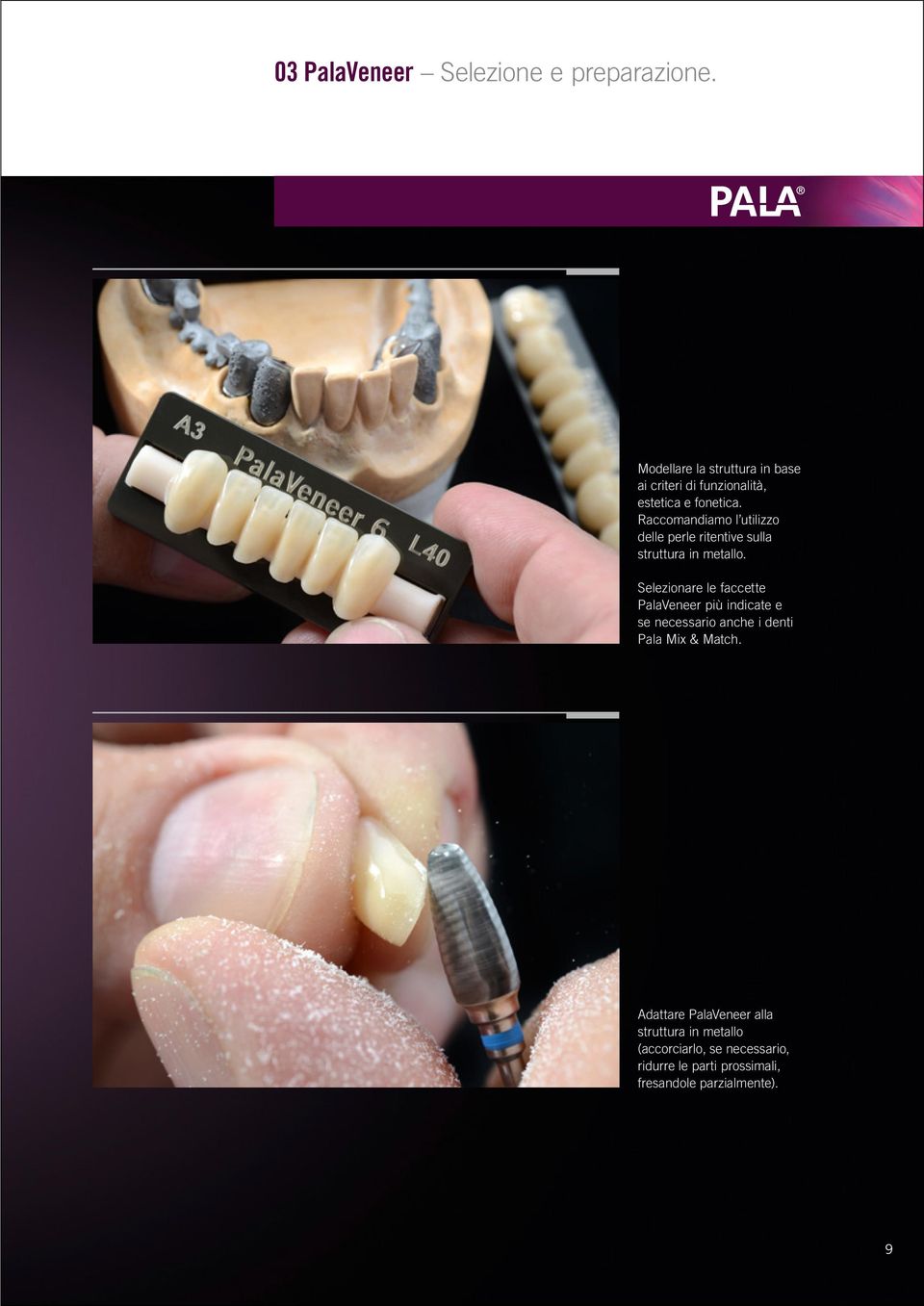 Raccomandiamo l utilizzo delle perle ritentive sulla struttura in metallo.