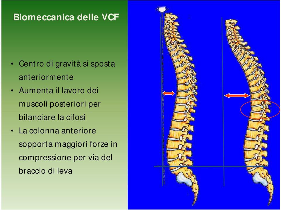 per bilanciare la cifosi La colonna anteriore sopporta