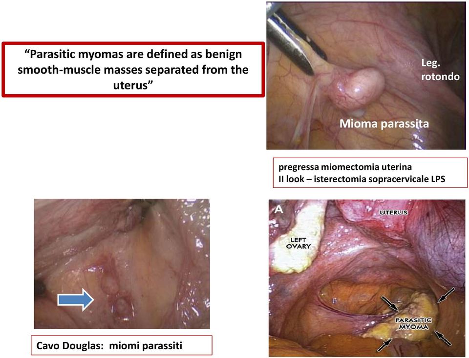 rotondo Mioma parassita pregressa miomectomia uterina II
