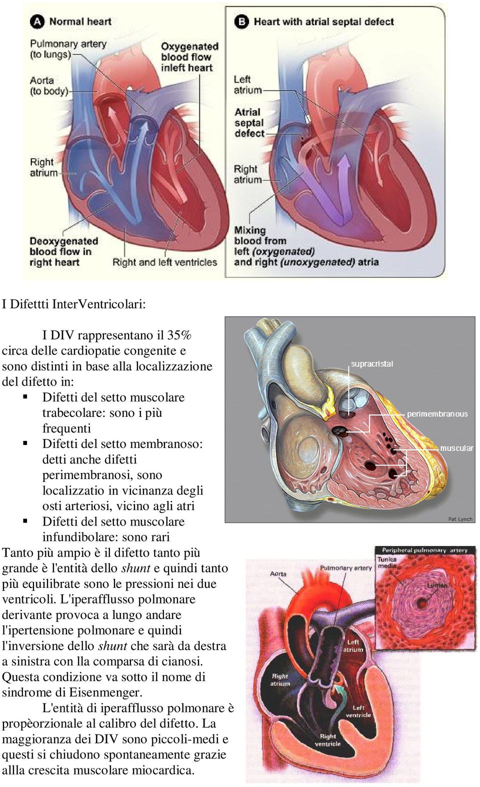 rari Tanto più ampio è il difetto tanto più grande è l'entità dello shunt e quindi tanto più equilibrate sono le pressioni nei due ventricoli.