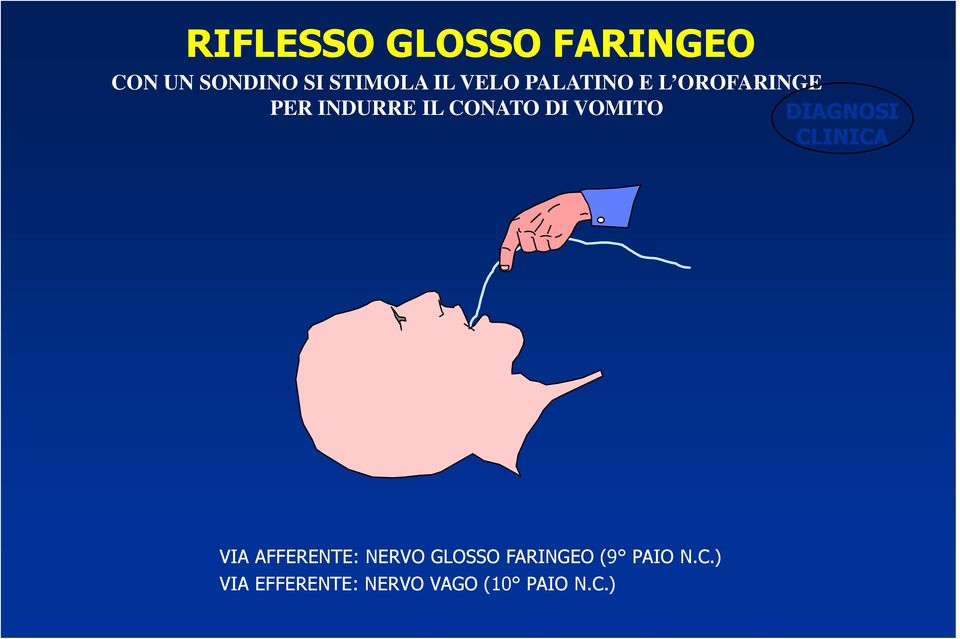 VOMITO DIAGNOSI CLINICA VIA AFFERENTE: NERVO GLOSSO