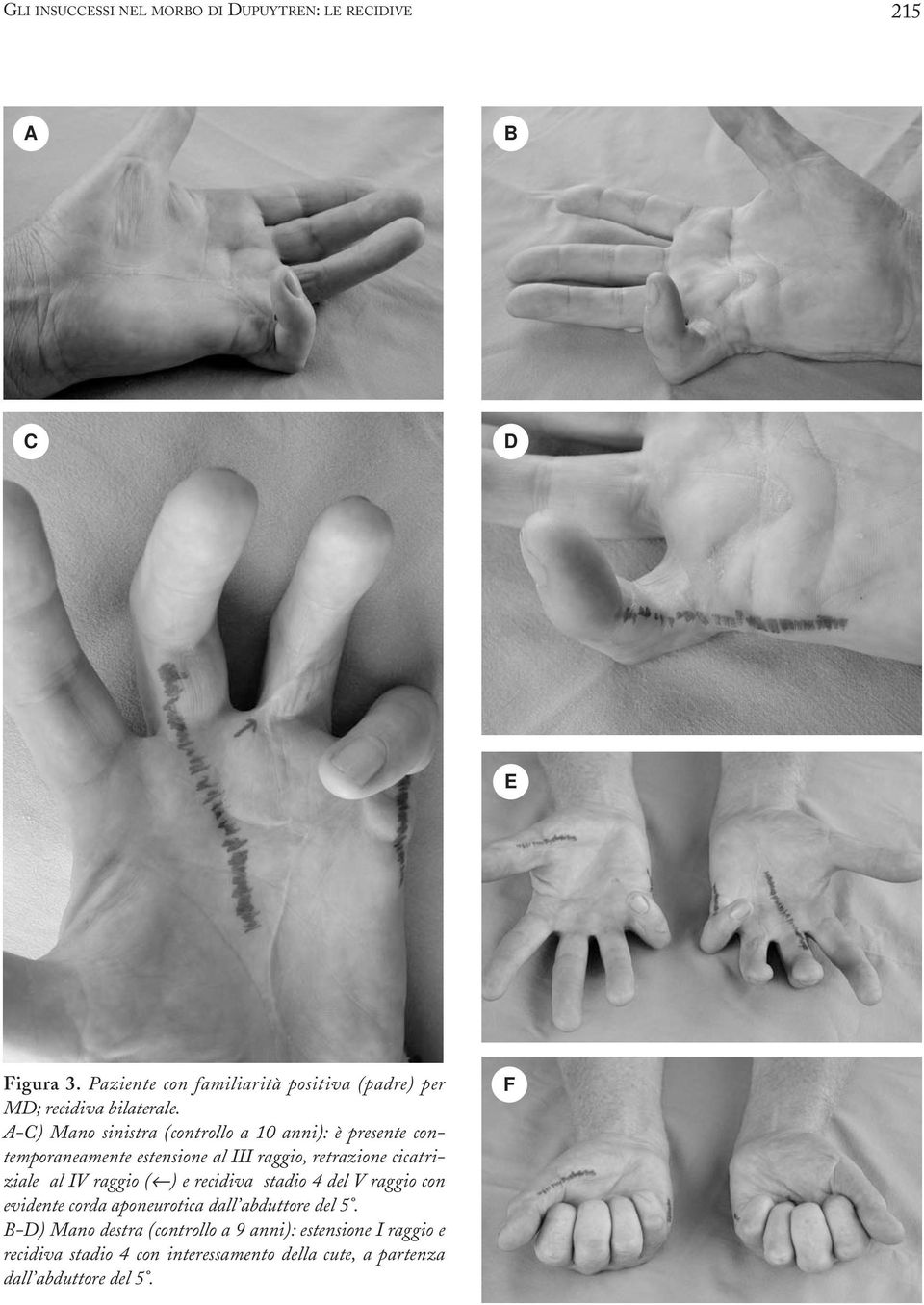 A-C) Mano sinistra (controllo a 10 anni): è presente contemporaneamente estensione al III raggio, retrazione cicatriziale al IV