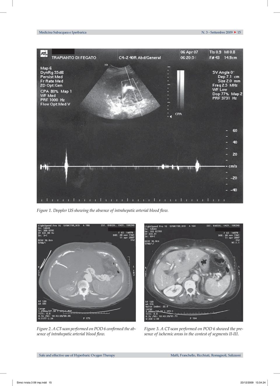 A CT-scan performed on POD 6 showed the presence of ischemic areas in the contest of segments II-III.