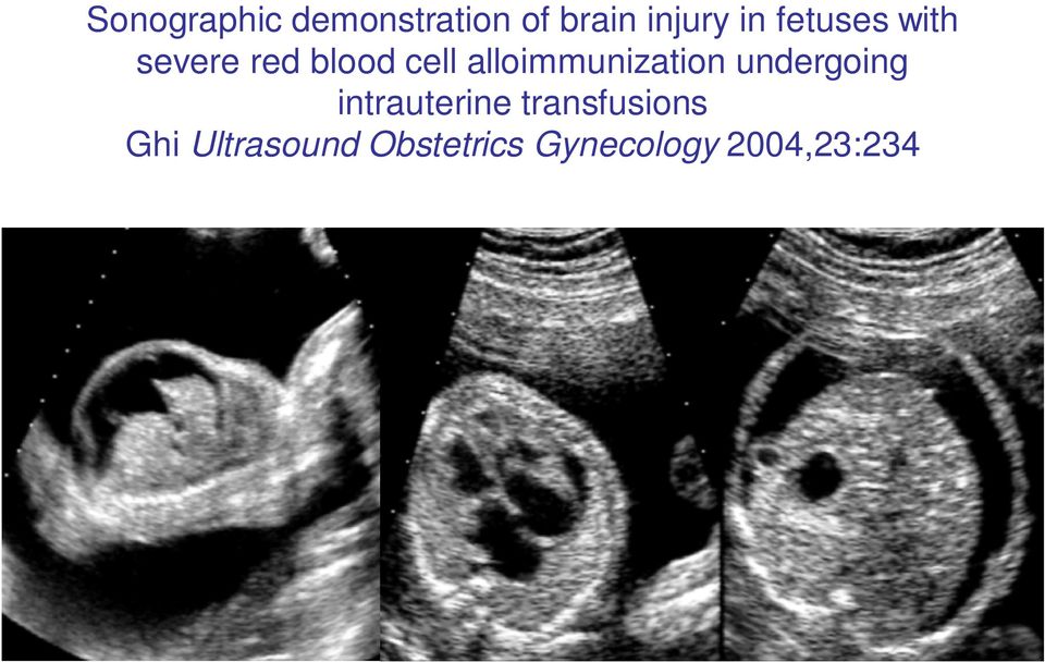 alloimmunization undergoing intrauterine