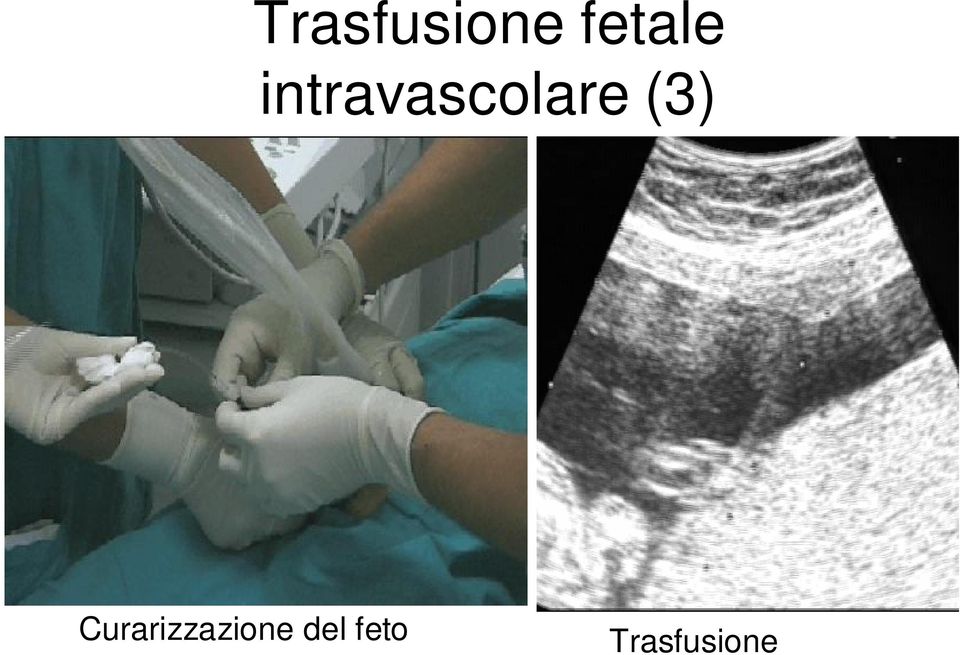 Curarizzazione del