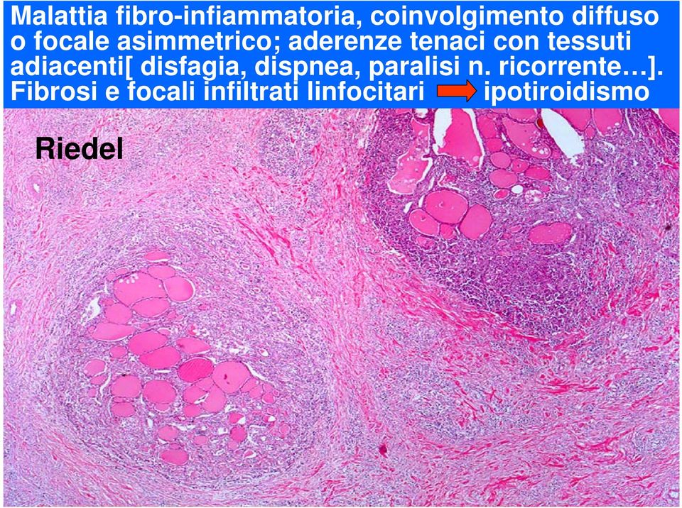 adiacenti[ disfagia, dispnea, paralisi n. ricorrente ].