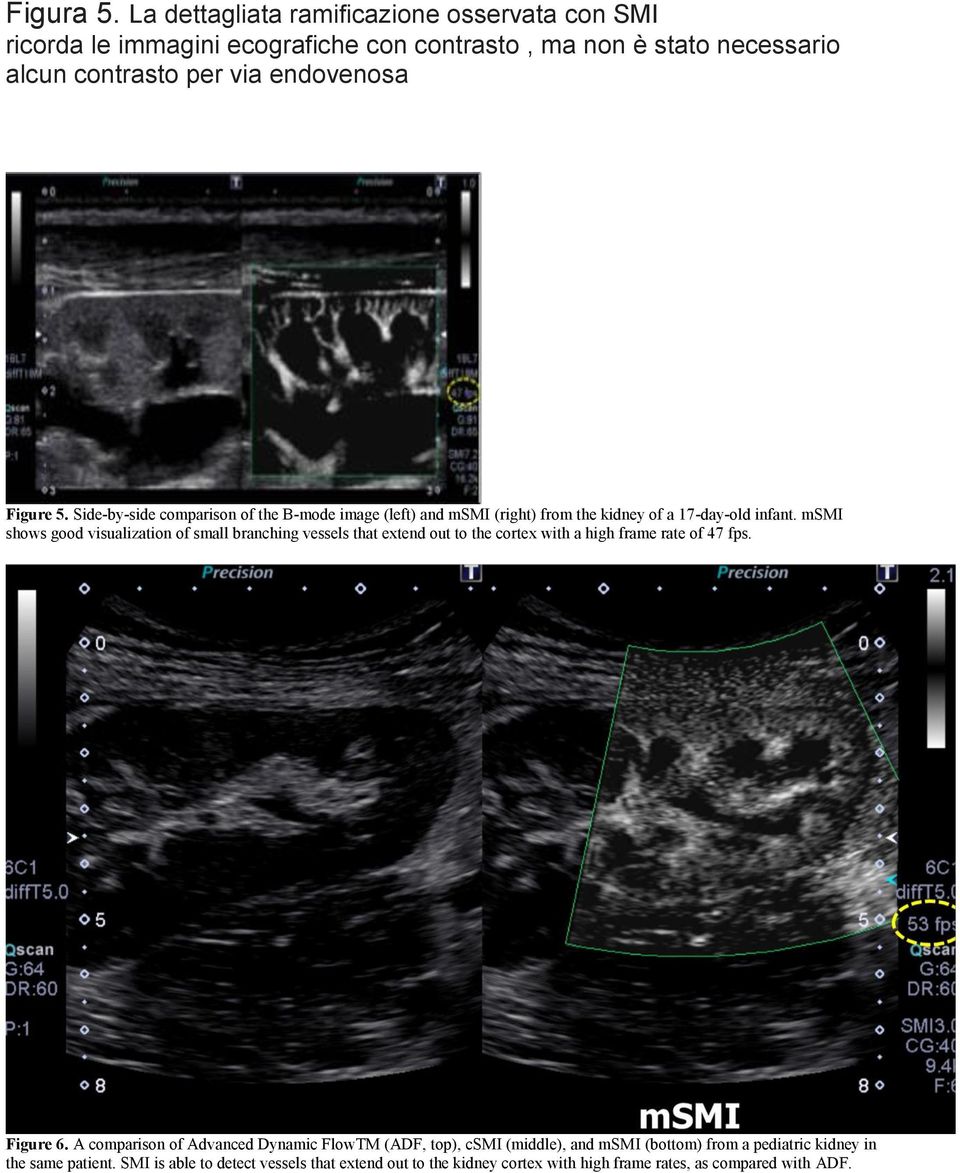 Side-by-side comparison of the B-mode image (left) and msmi (right) from the kidney of a 17-day-old infant.