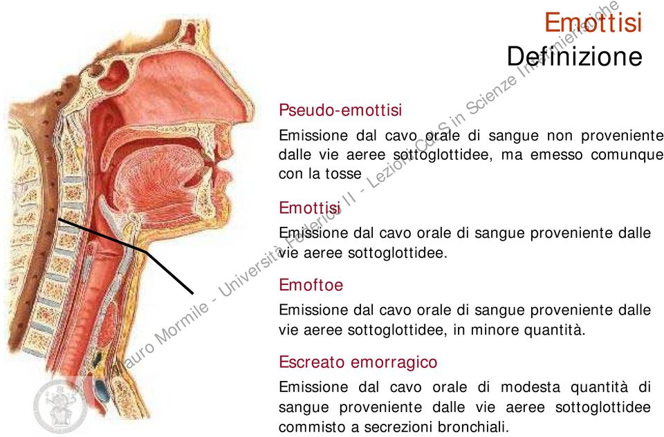 Emoftoe Emissione dal cavo orale di sangue proveniente dalle vie aeree sottoglottidee, in minore quantità.