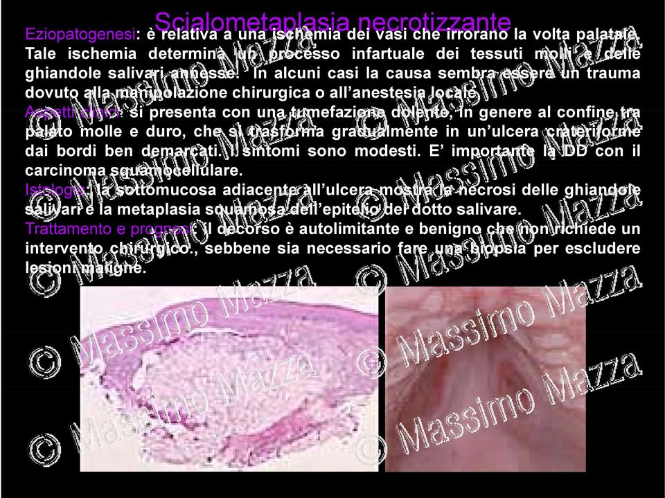 In alcuni casi la causa sembra essere un trauma dovuto alla manipolazione chirurgica o all anestesia locale.