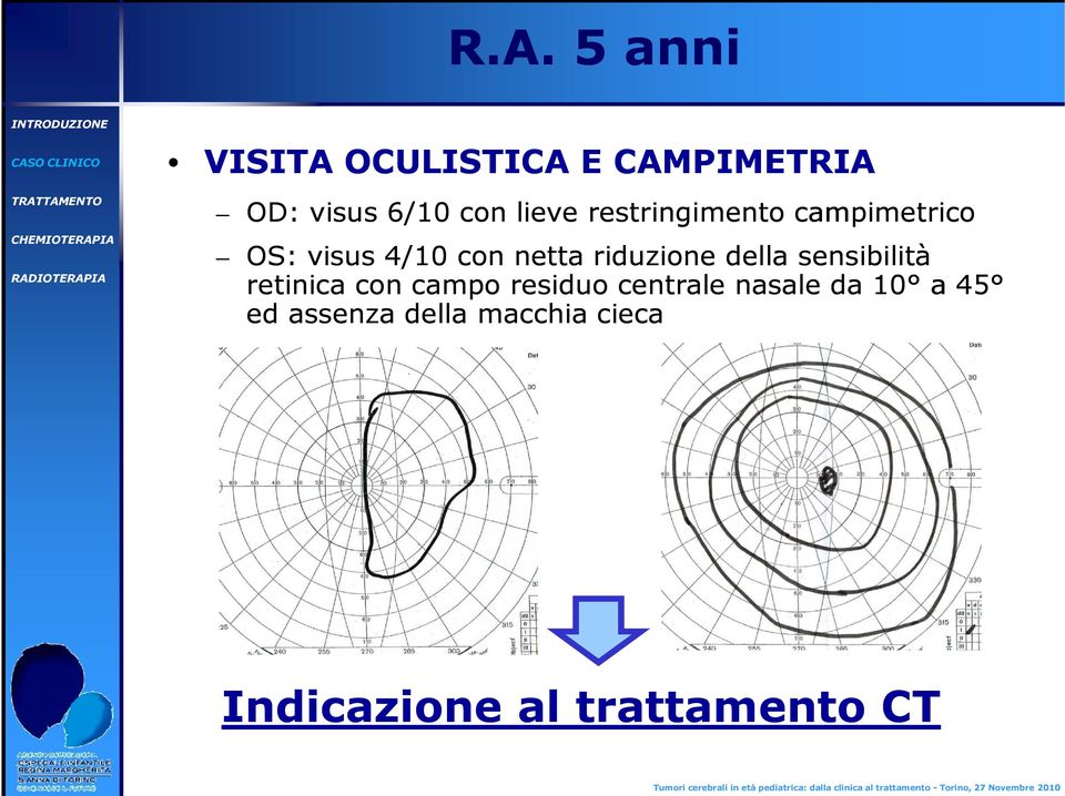 riduzione della sensibilità retinica con campo residuo centrale