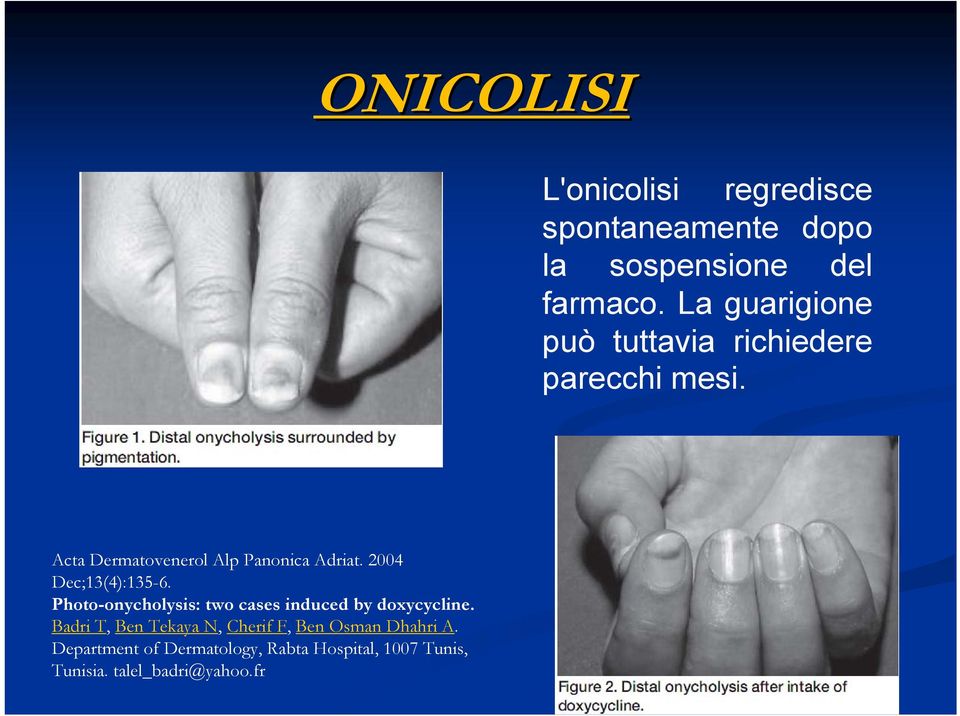 2004 Dec;13(4):135-6. Photo-onycholysis: two cases induced by doxycycline.