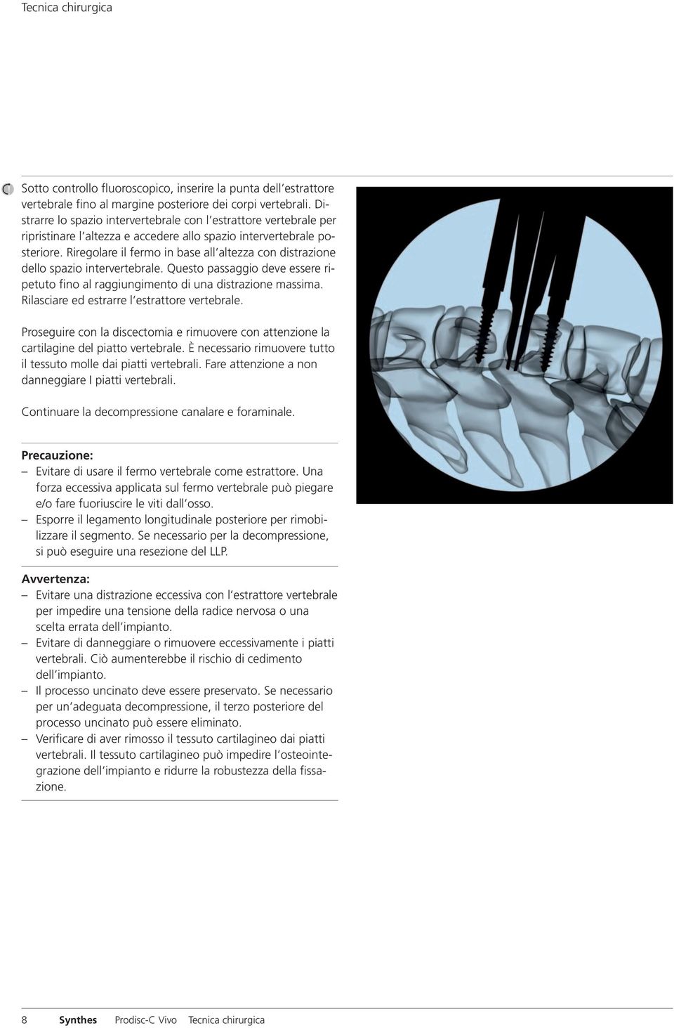 Riregolare il fermo in base all altezza con distrazione dello spazio intervertebrale. Questo passaggio deve essere ripetuto fino al raggiungimento di una distrazione massima.