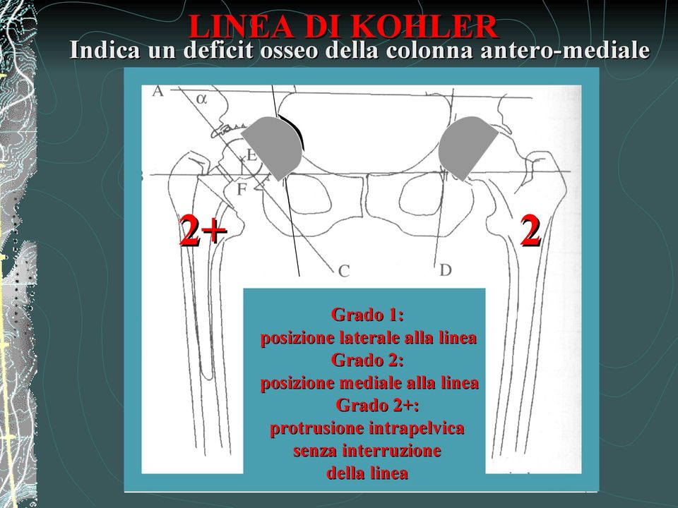 linea Grado 2: posizione mediale alla linea Grado 2+: