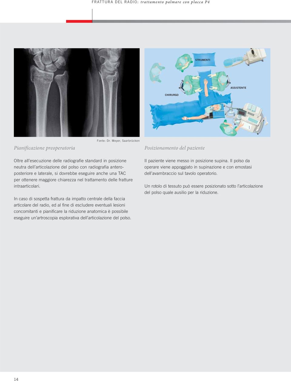 dovrebbe eseguire anche una TAC per ottenere maggiore chiarezza nel trattamento delle fratture intraarticolari.