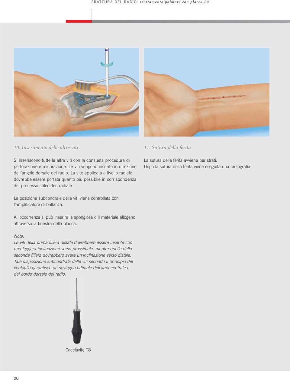 Sutura della ferita La sutura della ferita avviene per strati. Dopo la sutura della ferita viene eseguita una radiografia.