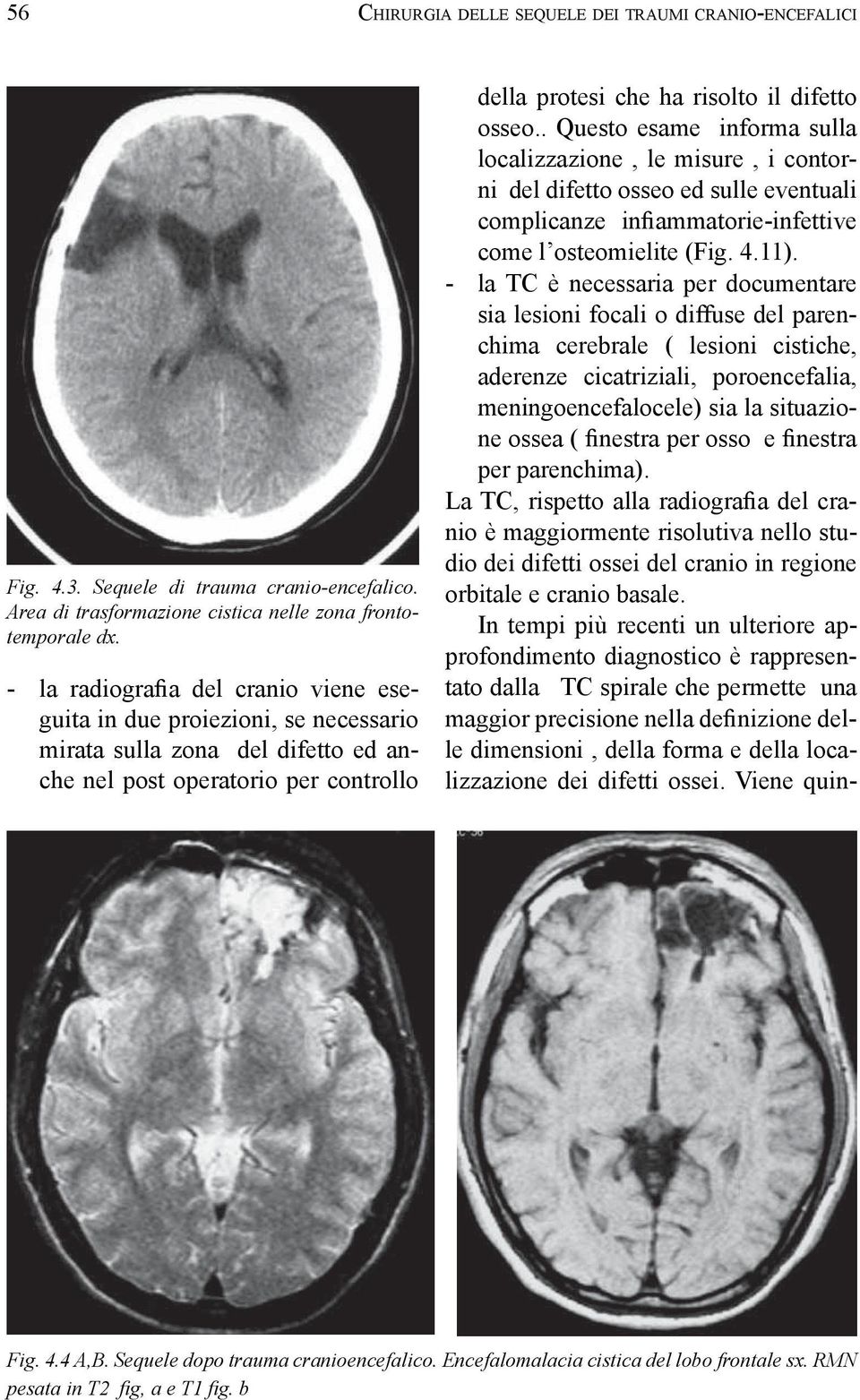 . Questo esame informa sulla localizzazione, le misure, i contorni del difetto osseo ed sulle eventuali come l osteomielite (Fig. 4.11).