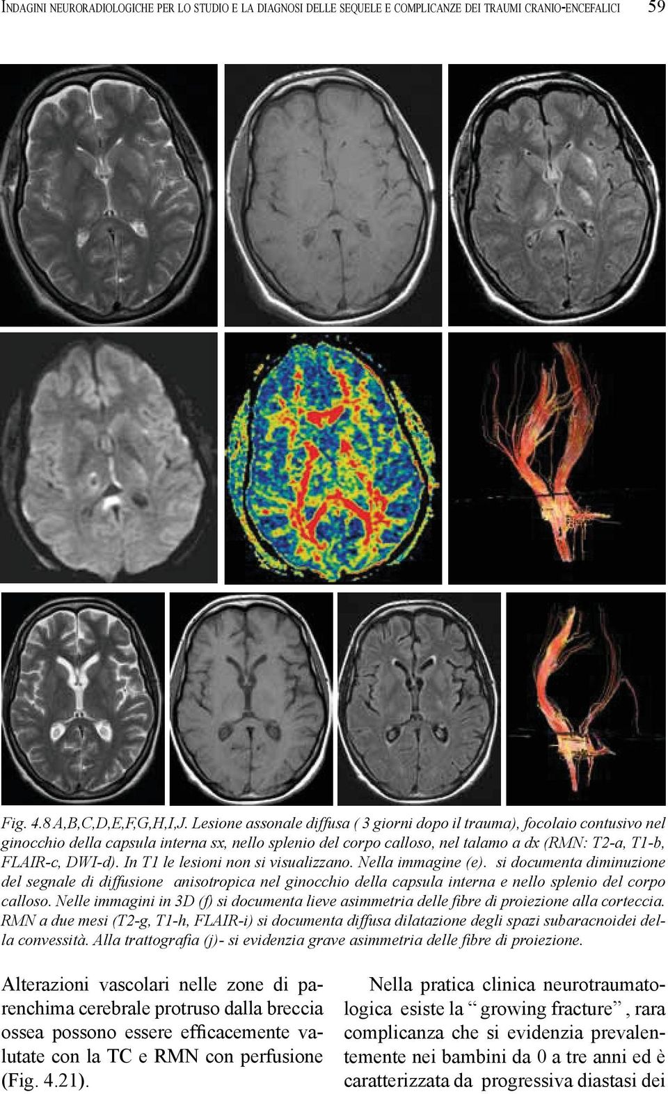 parenchima cerebrale protruso dalla breccia lutate con la TC e RMN con perfusione (Fig. 4.21).