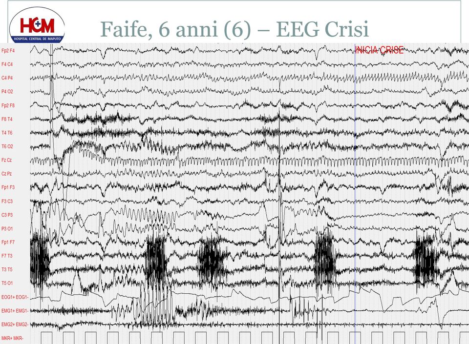 EEG Crisi