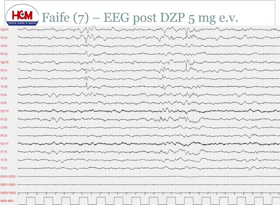 DZP 5 mg