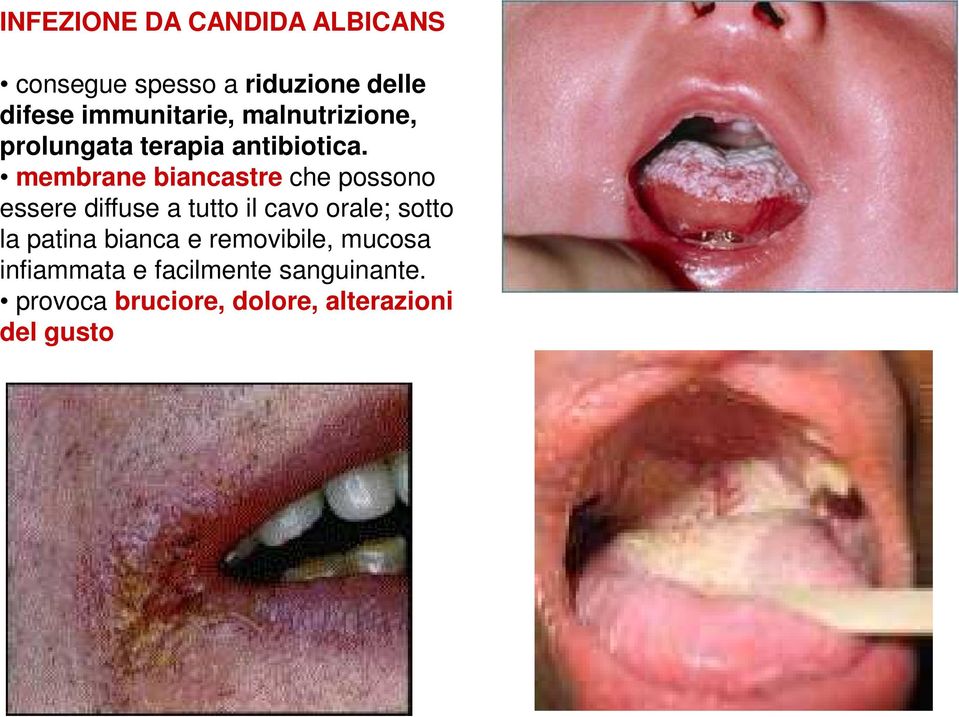 membrane biancastre che possono essere diffuse a tutto il cavo orale; sotto la