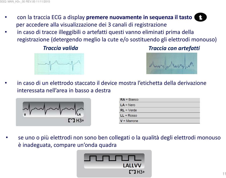 monouso) Traccia valida Traccia con artefatti in caso di un elettrodo staccato il devicemostra l etichetta della derivazione interessata nell