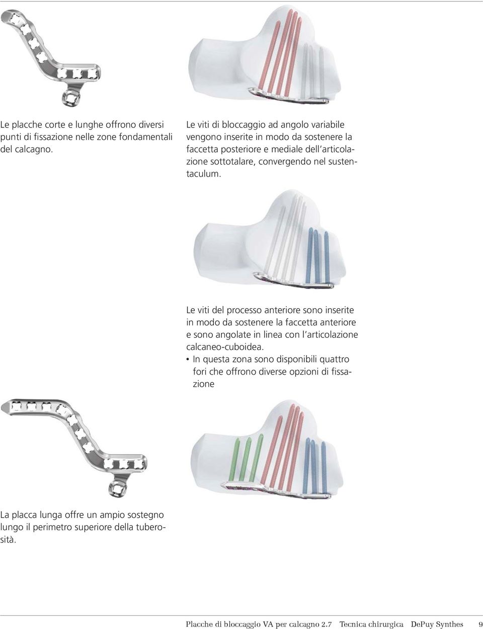 sustentaculum. Le viti del processo anteriore sono inserite in modo da sostenere la faccetta anteriore e sono angolate in linea con l articolazione calcaneo-cuboidea.