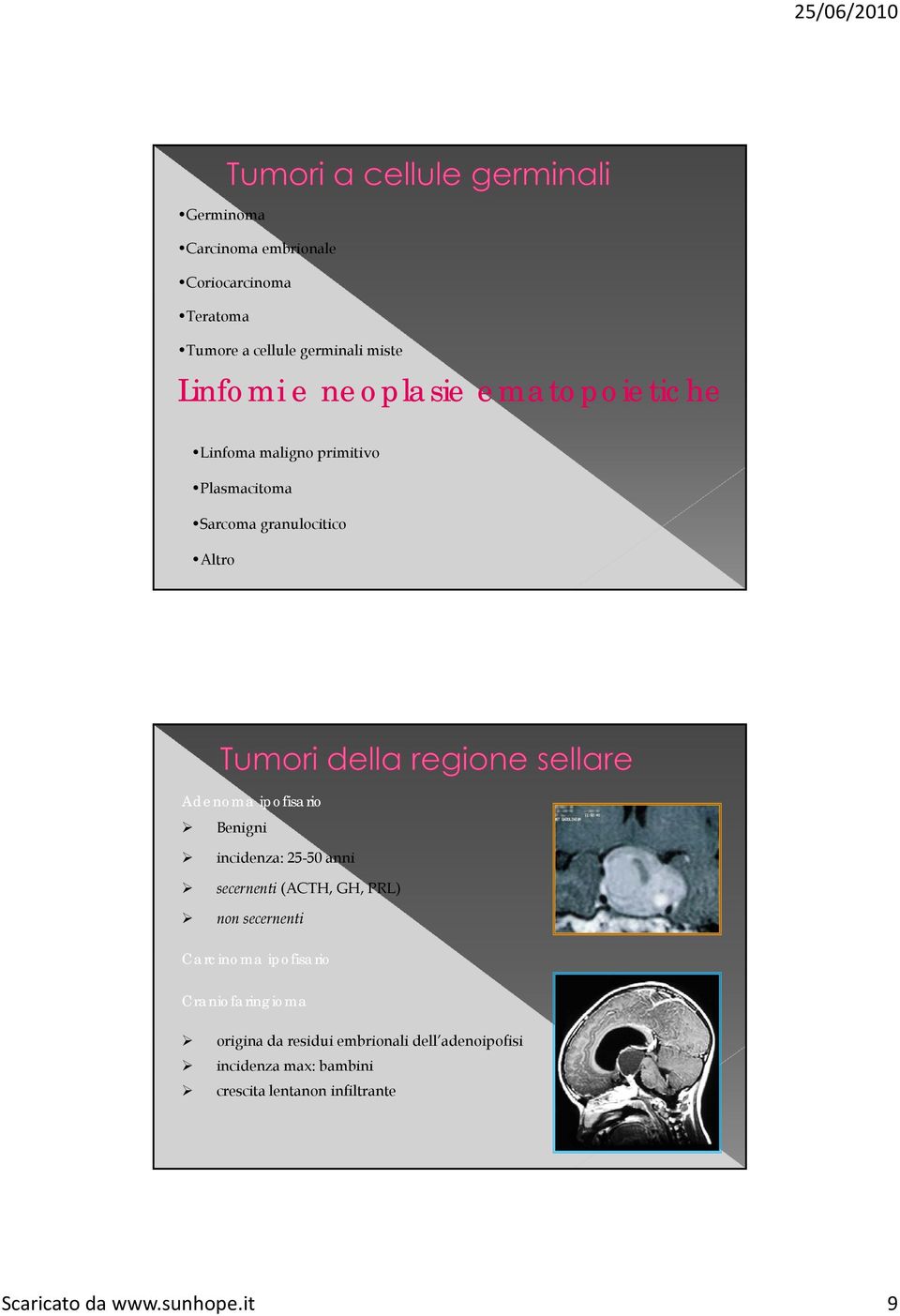 incidenza: 25-50 anni secernenti (ACTH, GH, PRL) non secernenti Carcinoma ipofisario Craniofaringioma origina da