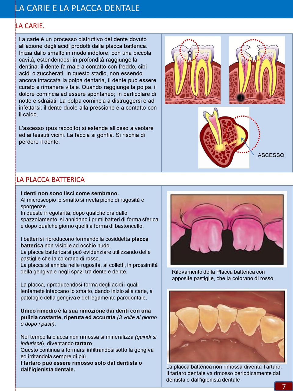 In questo stadio, non essendo ancora intaccata la polpa dentaria, il dente può essere curato e rimanere vitale.