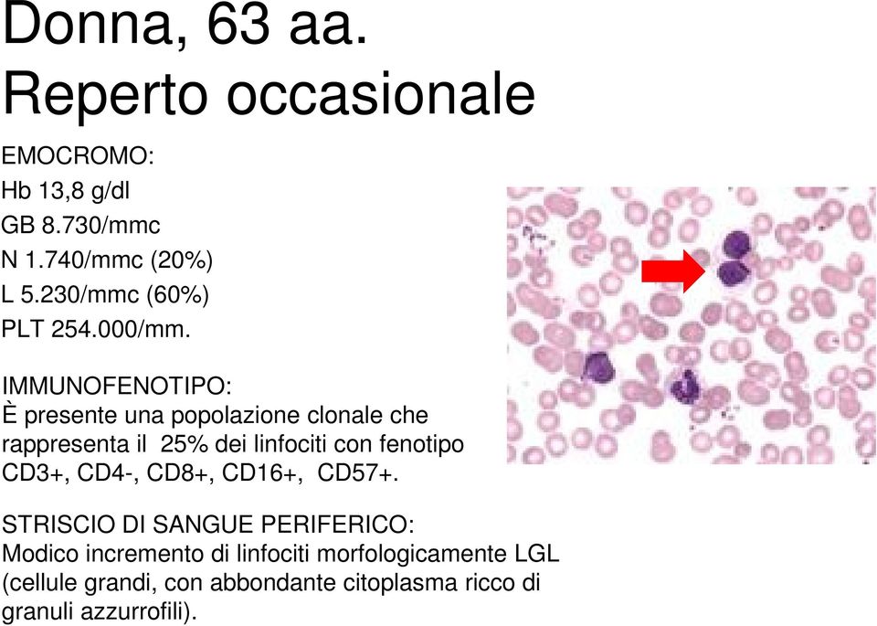 IMMUNOFENOTIPO: È presente una popolazione clonale che rappresenta il 25% dei linfociti con fenotipo